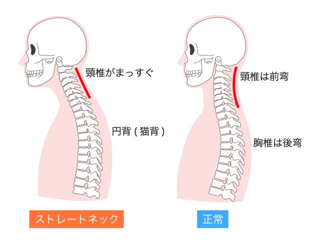 ストレートネック