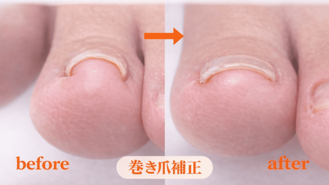 軽度の巻き爪/20代女性